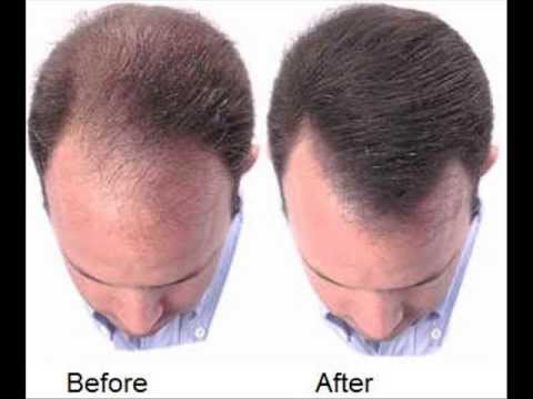 lower dht regrow hair